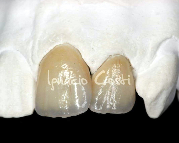 Carillas de disilicato · Disilicato · Laboratorio Ignacio Costi Madrid